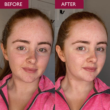 Pro-Radiance Enzyme Peel 50ml